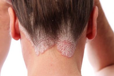 Dermatite Seborreica: No Rosto, Causas, Tratamento!
